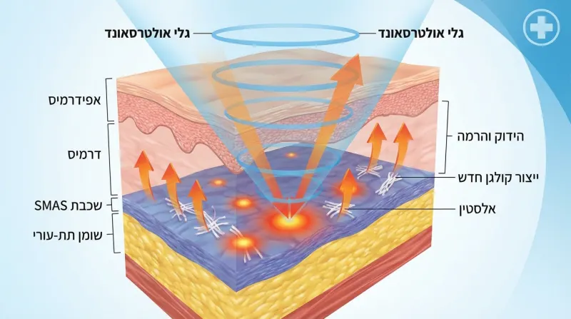 HIFU: מה זה עושה, למי זה מתאים ומתי לא כדאי להתקרב