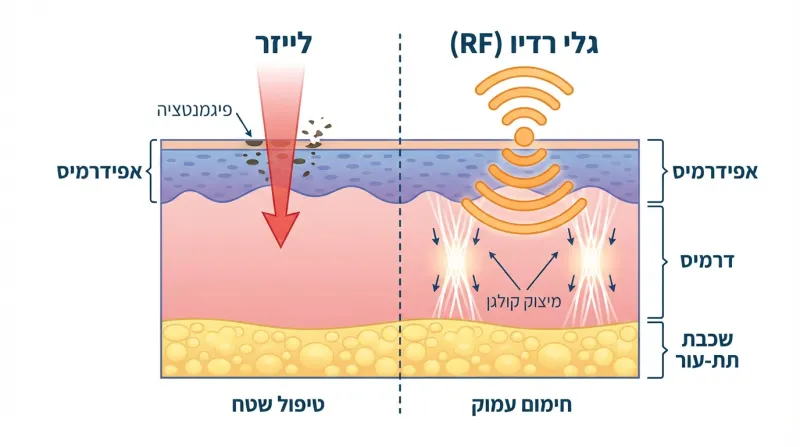 גלי רדיו מול לייזר: מה ההבדל בחידוש העור ומה עדיף למיצוק